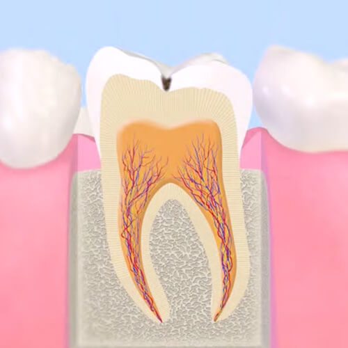 初期のむし歯治療（C1）