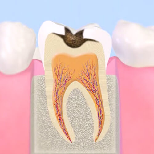 進行したむし歯治療（C2）