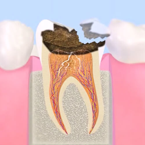 歯髄まで進行したむし歯治療 （C3）