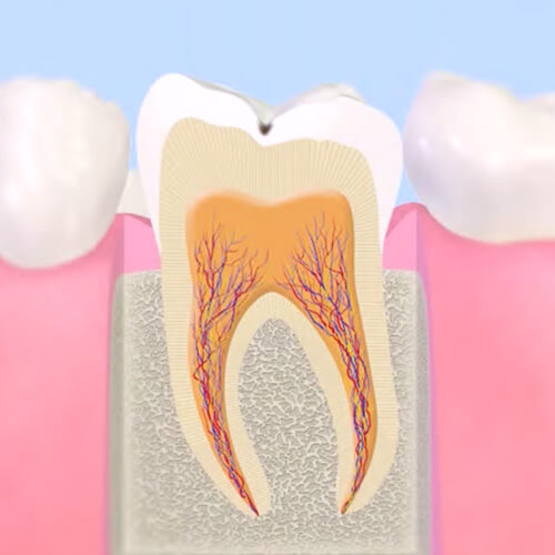 初期のむし歯治療（CO）