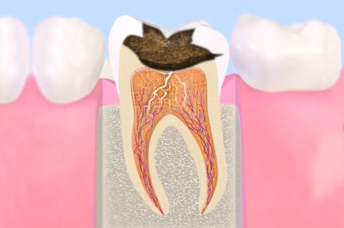 むし歯治療イメージ